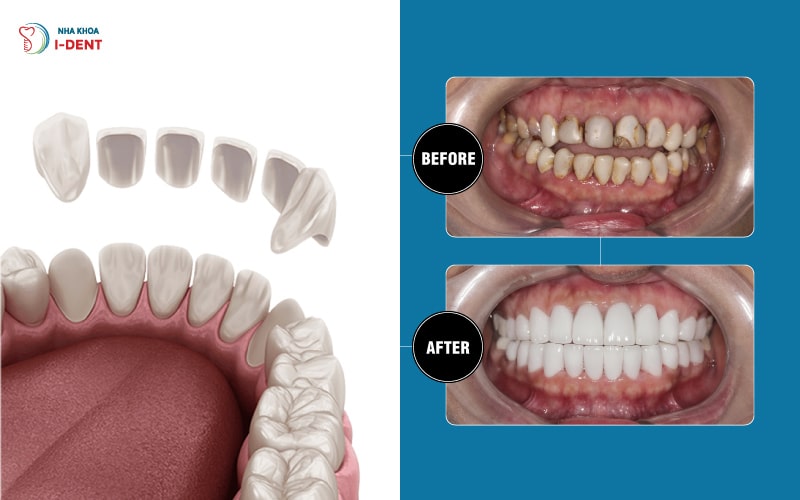 Bọc răng sứ cả hàm cho răng bị ố màu nặng