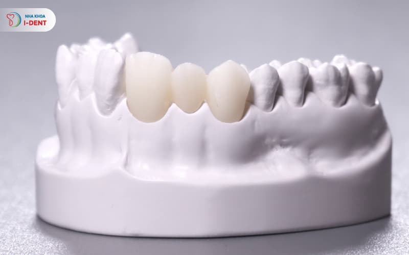 Răng sứ Cercon phục hình tối ưu chức năng ăn nhai và thẩm mỹ như răng thật 