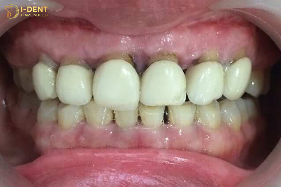 bọc răng sứ có hại gì không