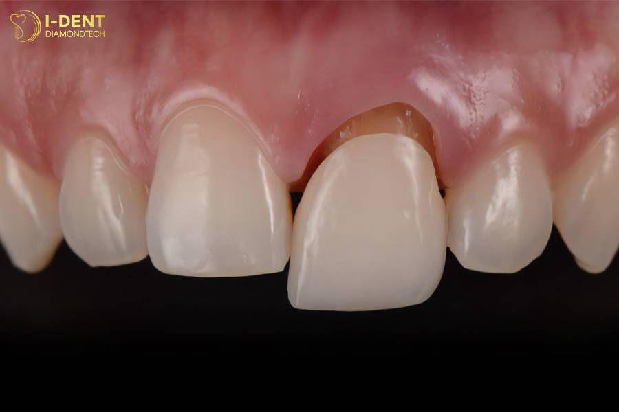 bọc răng sứ có bị rơi ra không