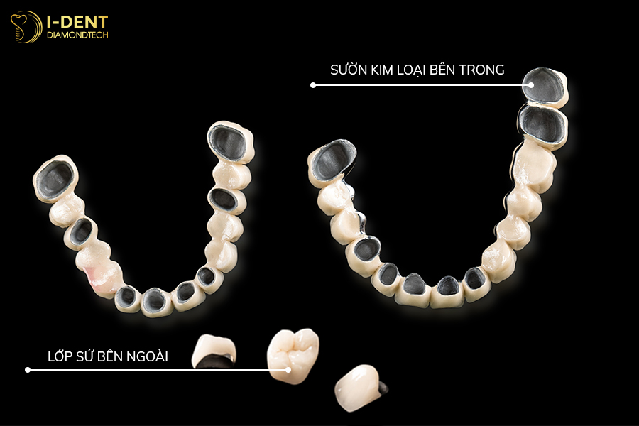 tác hại răng kim loại