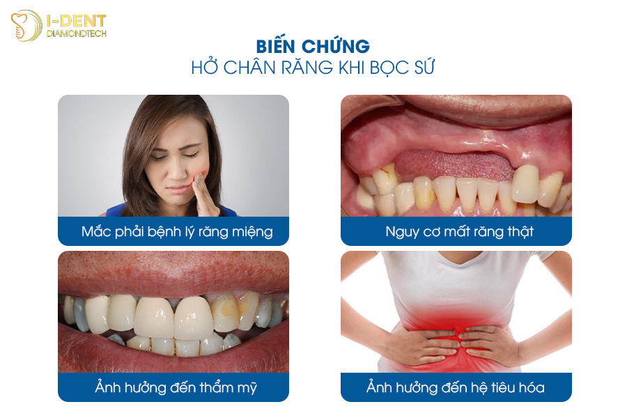 bọc răng sứ không khít