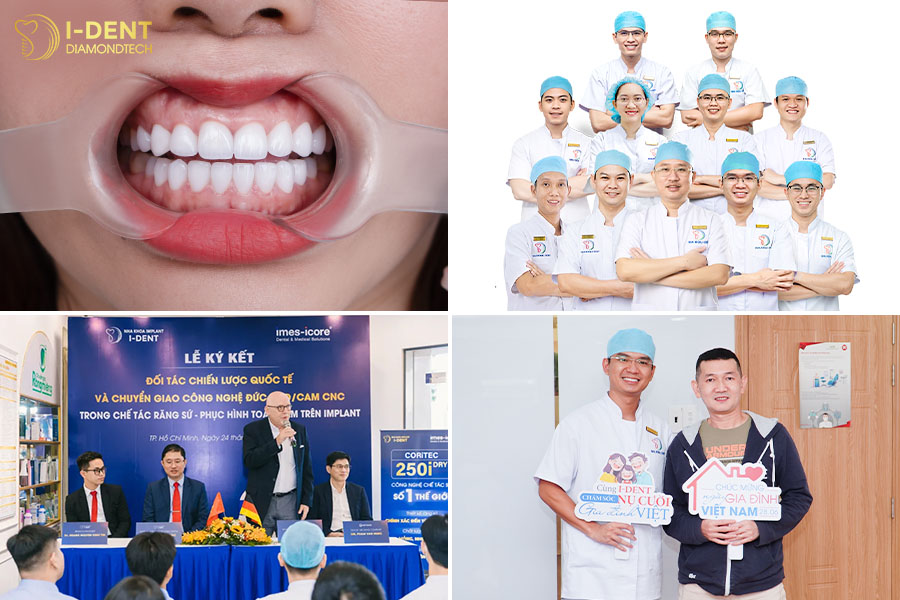 răng toàn sứ multilayer ddbio cao cấp