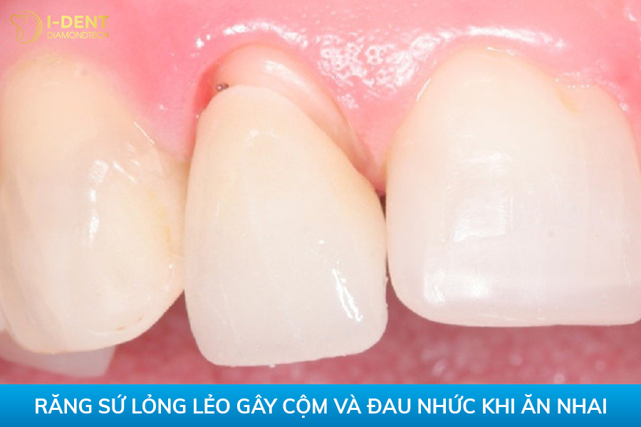 bọc răng sứ bị hở chân