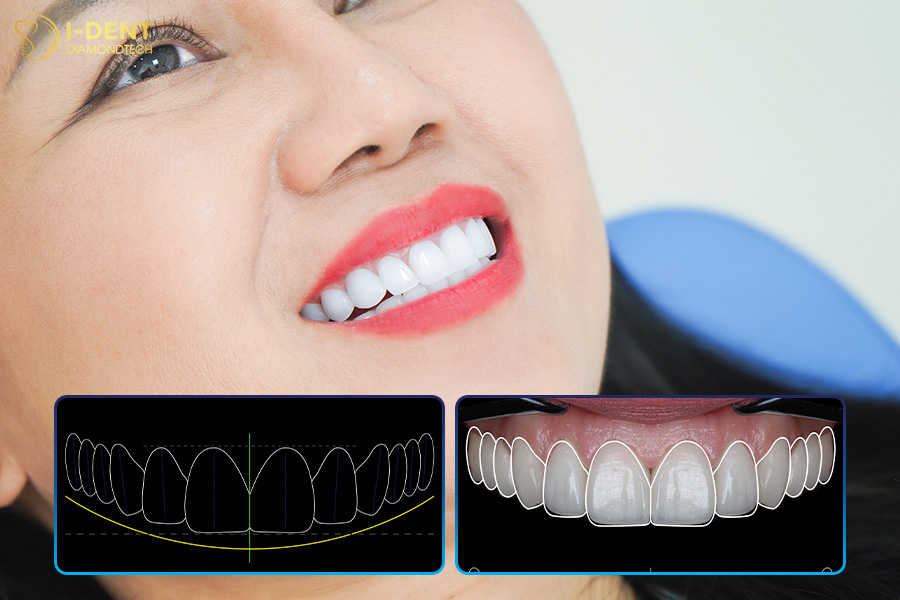 công nghệ digital smile design