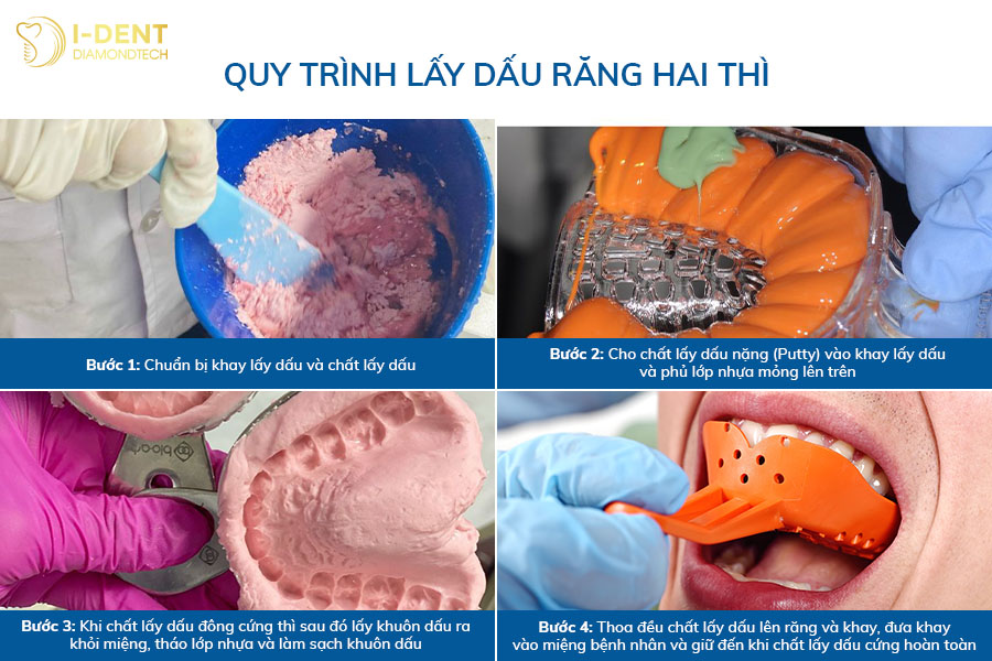 kỹ thuật lấy dấu răng sứ