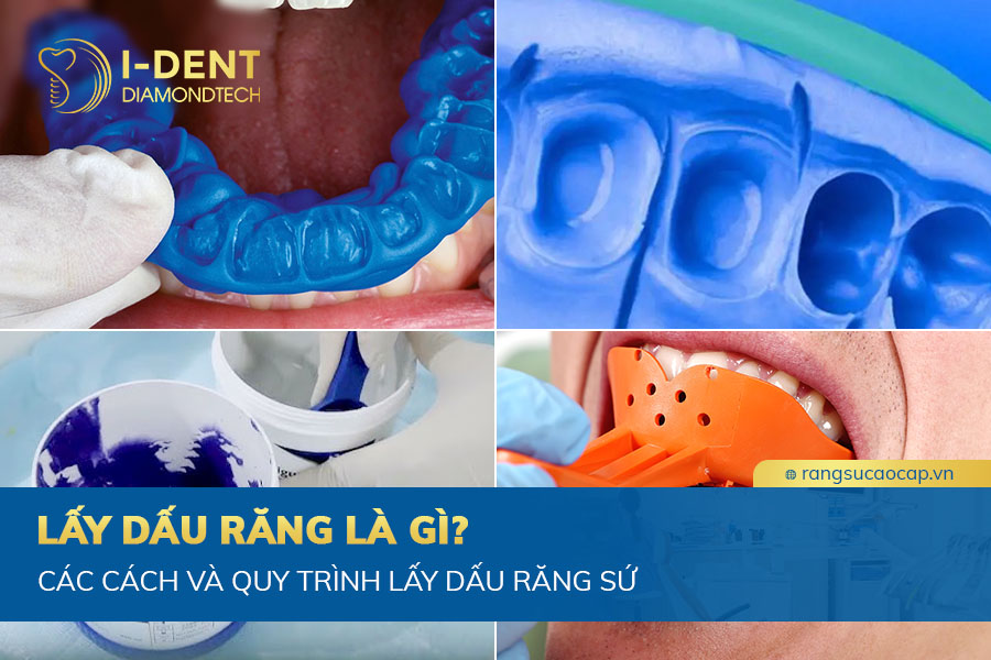 lấy dấu răng sứ