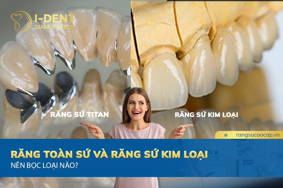 nên bọc răng sứ kim loại hay titan