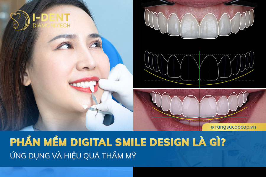 phần mềm digital smile design