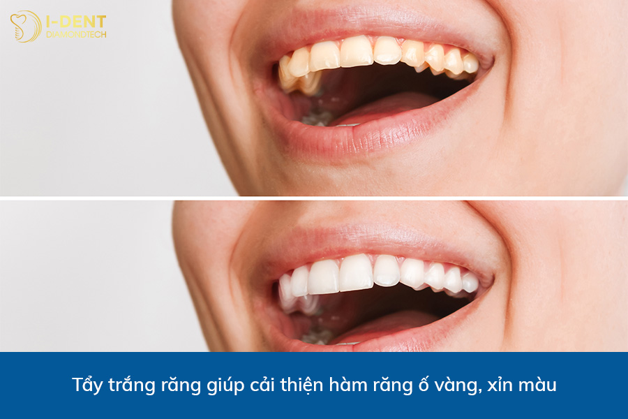 thẩm mỹ răng sứ