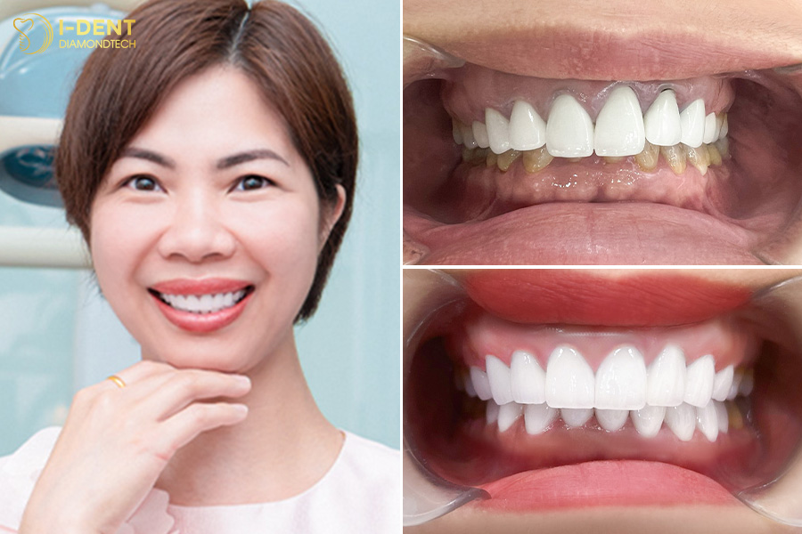 ưu điểm digital smile design