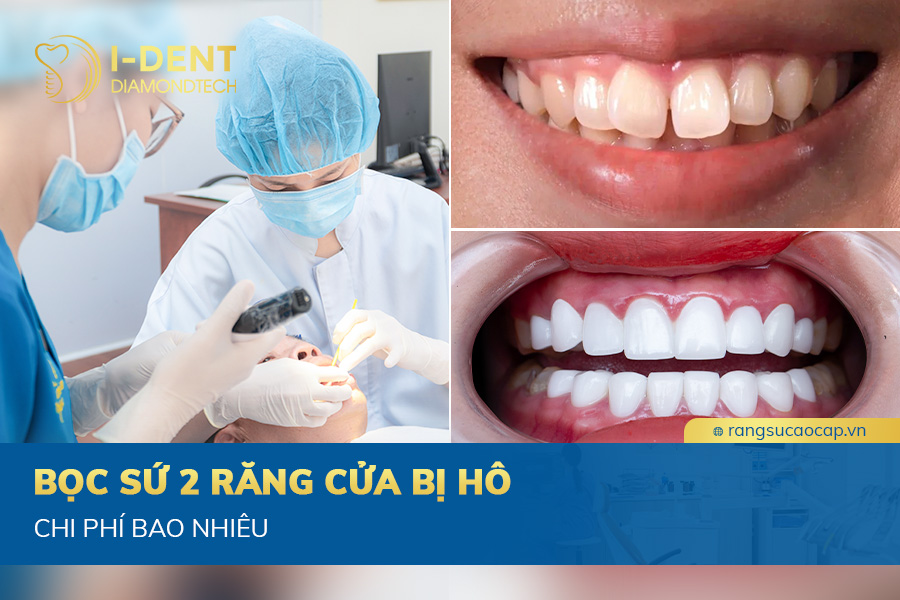 bọc sứ 2 răng cửa bị hô