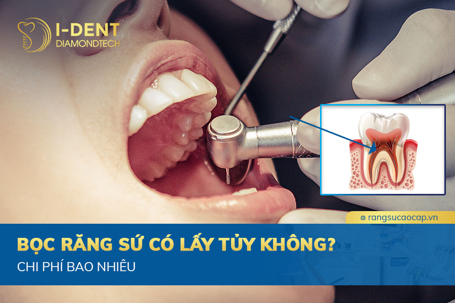 bọc răng sứ có lấy tủy không