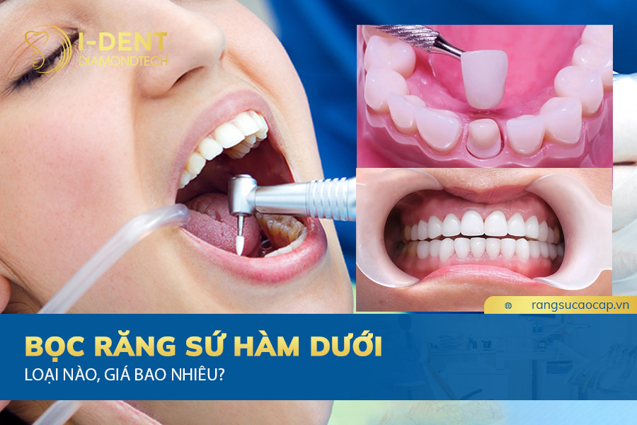 bọc răng sứ hàm dưới