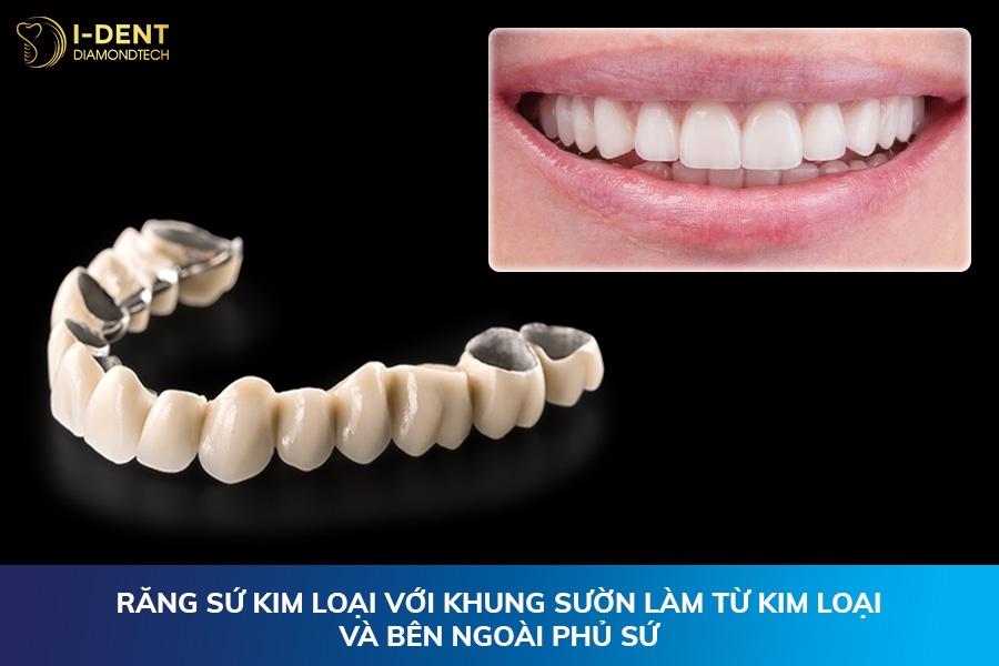 răng sứ kim loại và răng toàn sứ