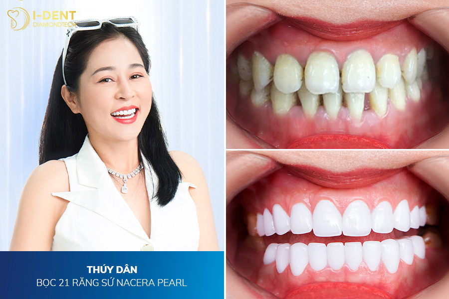 ảnh bọc răng sứ trước và sau