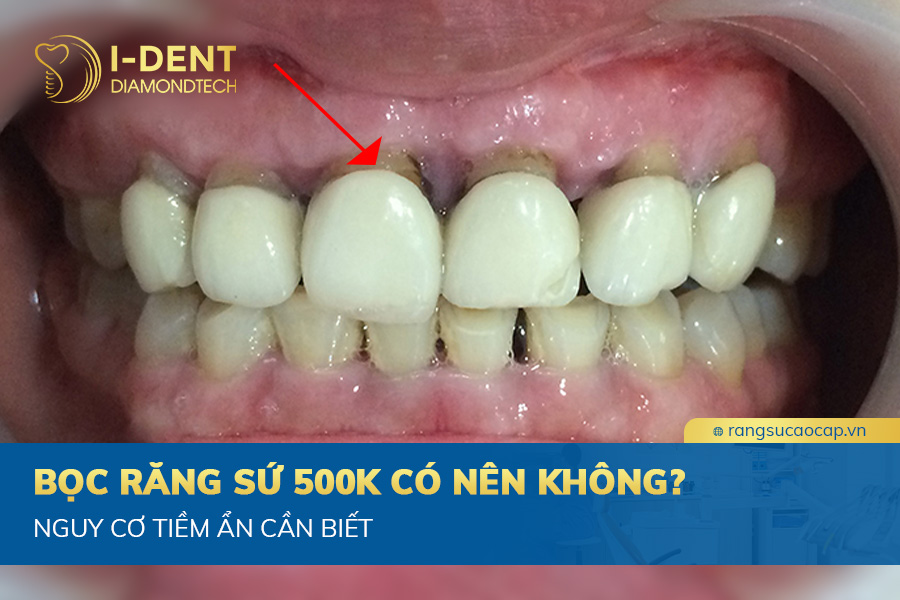 bọc răng sứ 500k