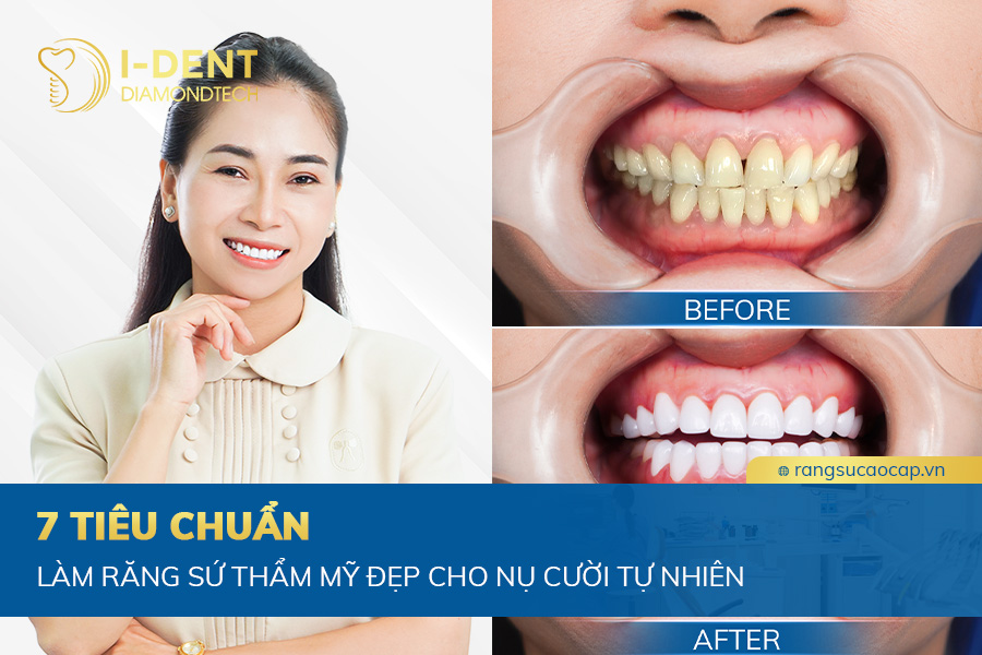 bọc răng sứ như thế nào là đẹp