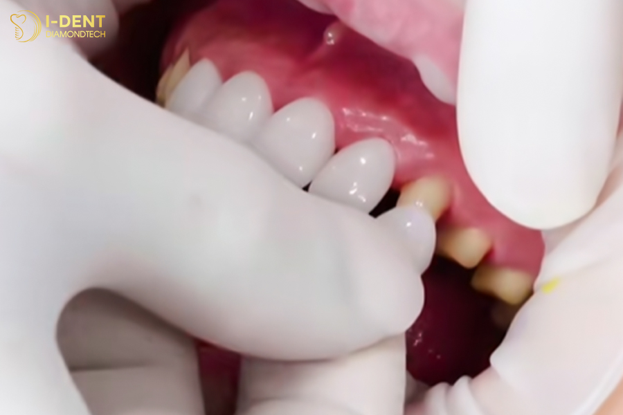 bọc răng sứ rồi có tháo ra được không