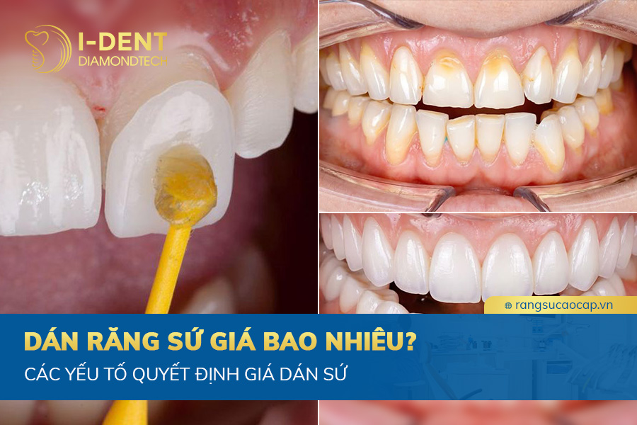 dán răng sứ giá bao nhiêu 1 răng