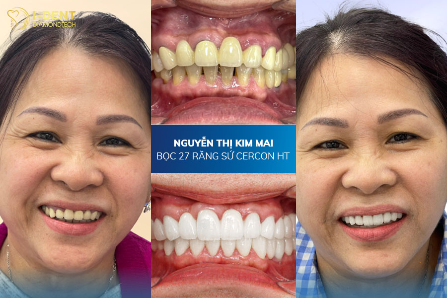 hình ảnh bọc răng sứ đẹp