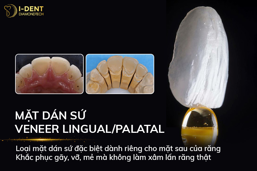 loại dán sứ veneer