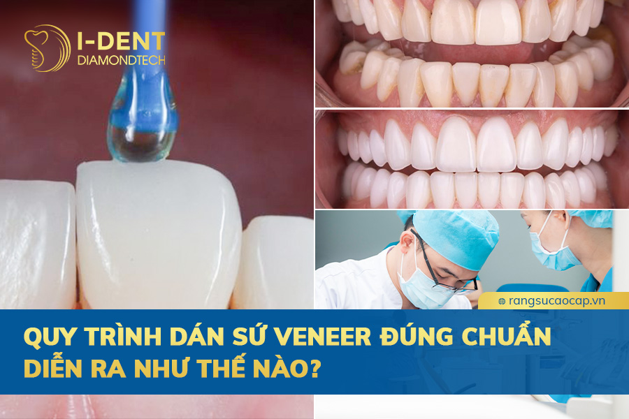 quy trình dán sứ veneer