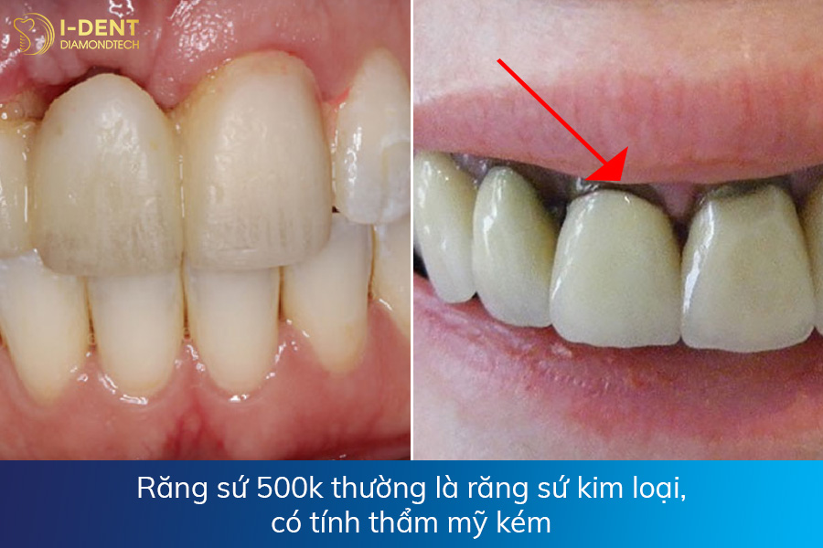 răng sứ 500k