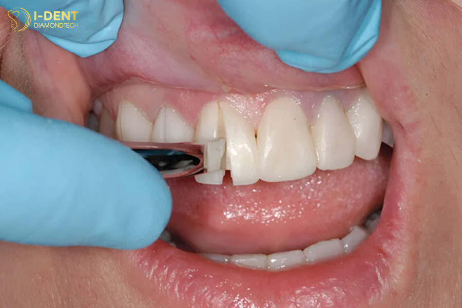 tháo răng sứ mất bao lâu