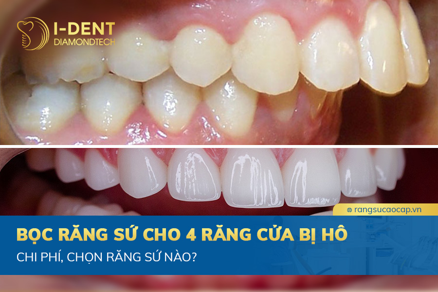 bọc răng sứ cho 4 răng cửa bị hô