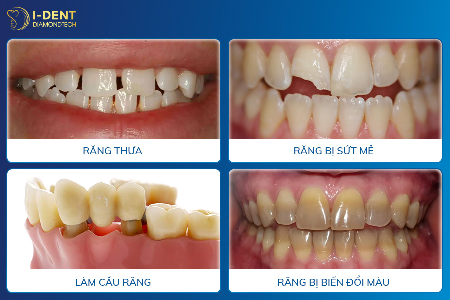 bọc răng sứ có cần lấy tủy không