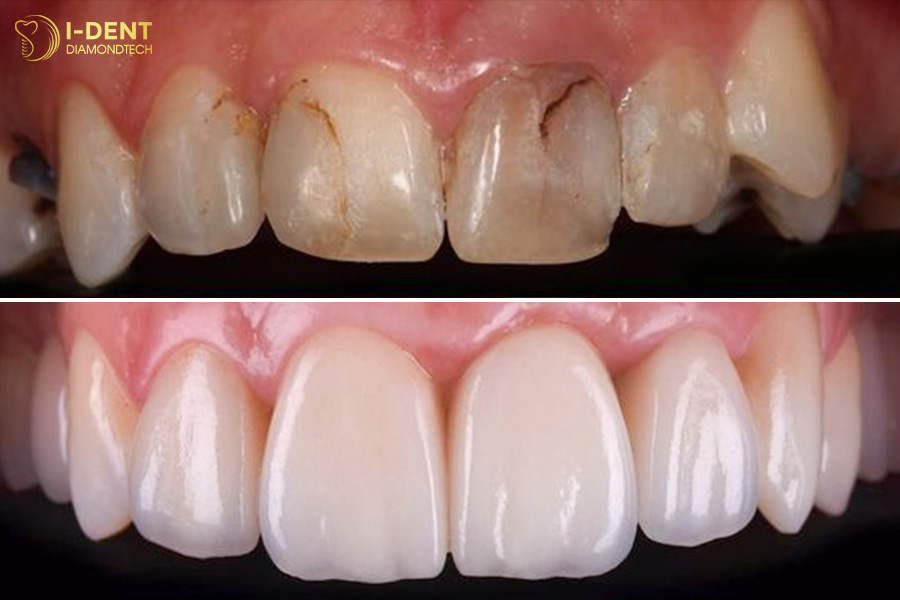 bọc răng sứ răng cửa bị sâu