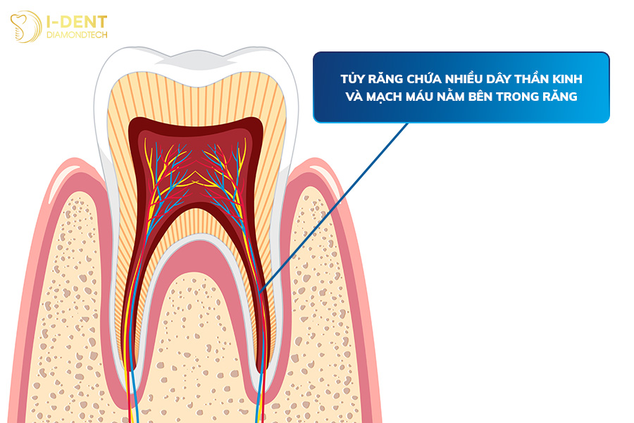 bọc răng sứ sau khi lấy tủy đau không