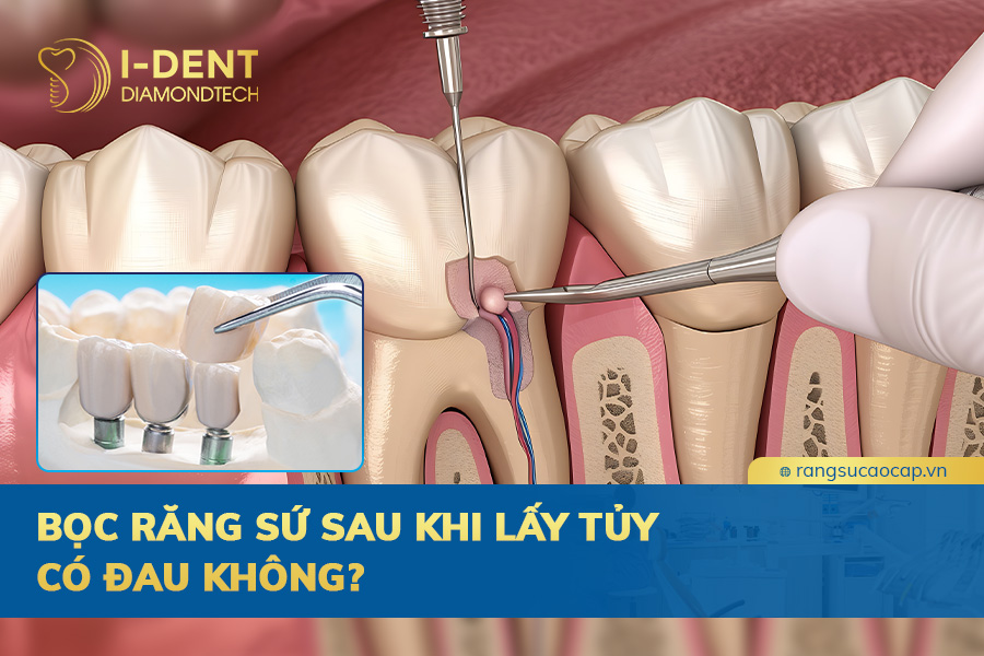 bọc răng sứ sau khi lấy tủy có đau không