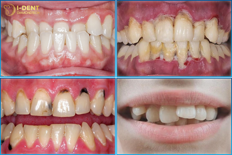 bọc sứ hàm răng trên