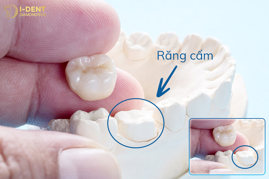 bọc sứ răng cấm