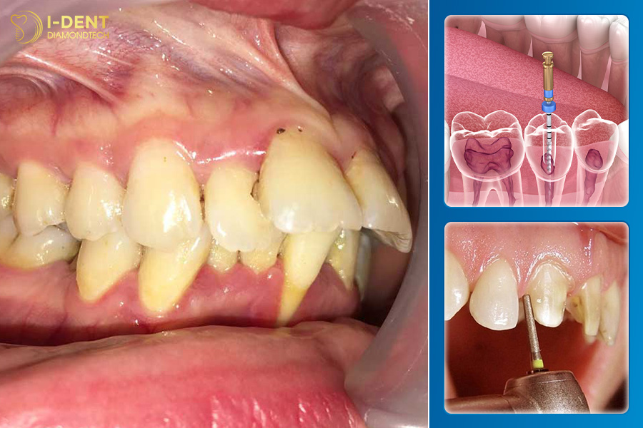 có nên bọc răng sứ sau khi lấy tủy