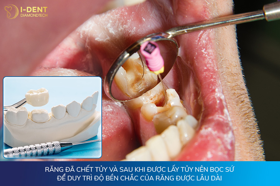 điều trị tủy răng có nên bọc sứ