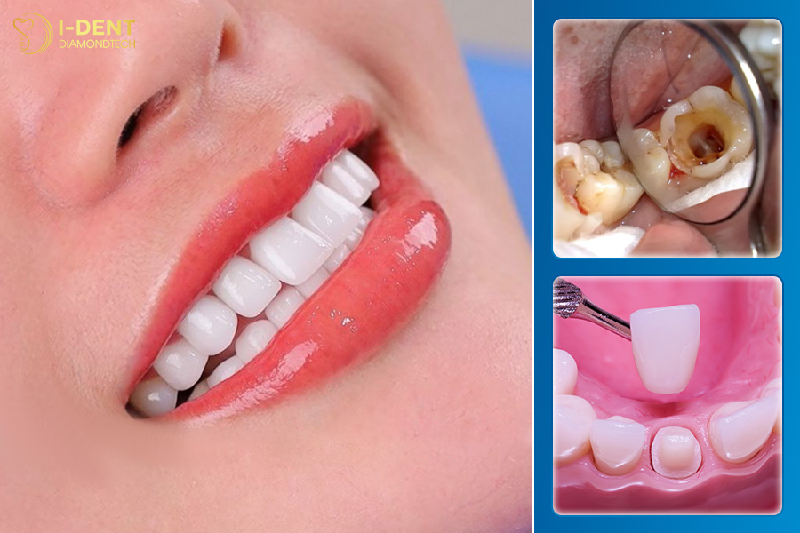 lấy tủy bọc răng sứ