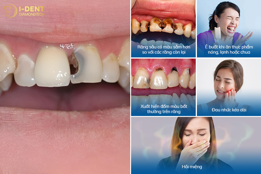răng cửa bị sâu có bọc sứ được không