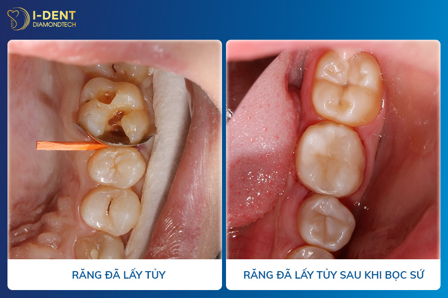 răng đã lấy tủy có nên bọc sứ không