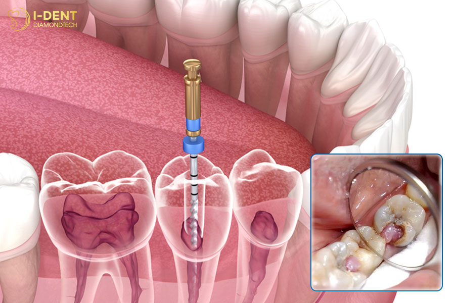 răng lấy tủy không bọc sứ có sao không