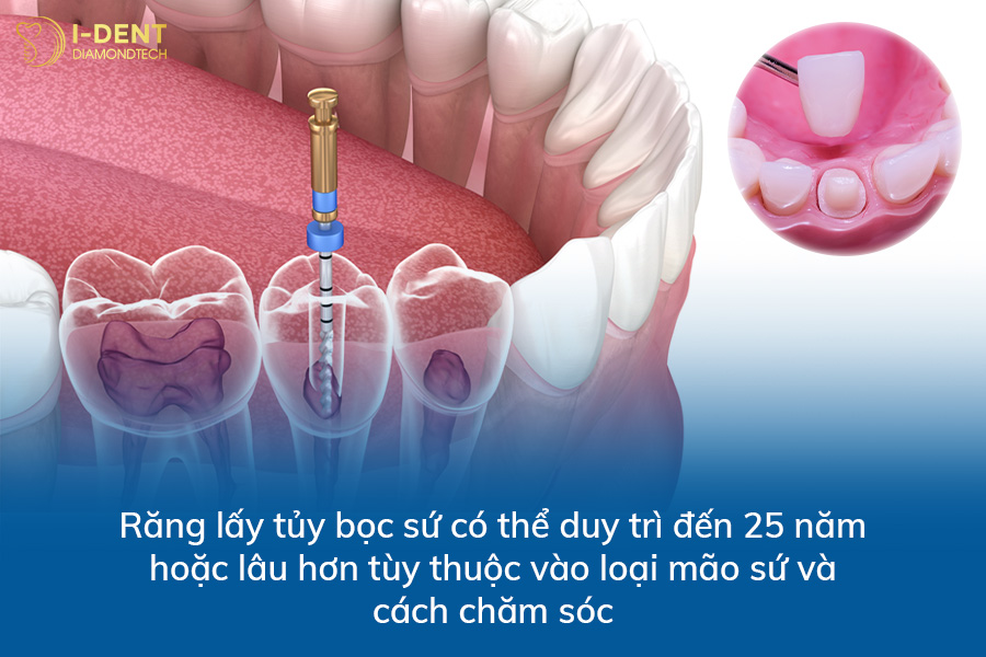 răng lấy tủy bọc sứ được bao lâu
