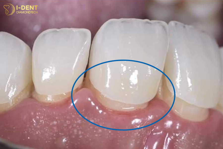 bọc sứ có hư răng không