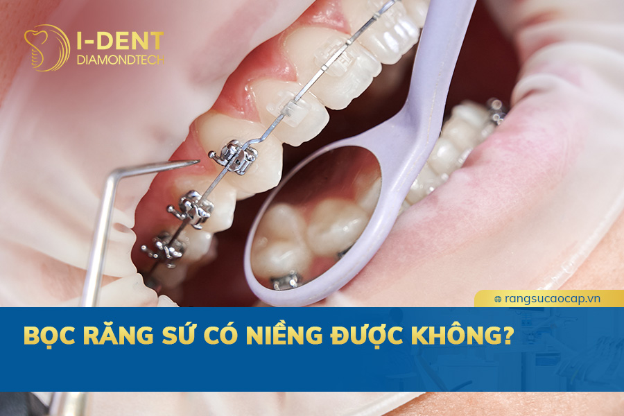 bọc răng sứ có niềng được không