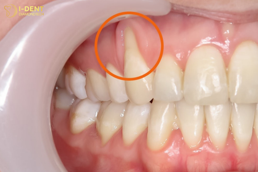 bọc răng sứ và những biến chứng khó lường