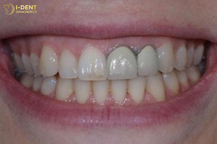 hậu quả bọc răng sứ