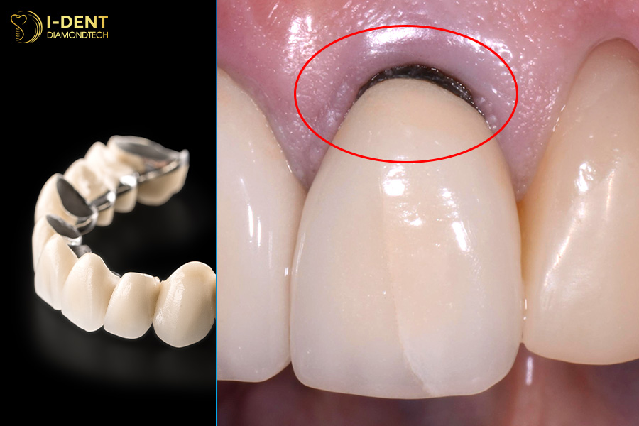 răng sứ kim loại bị đen