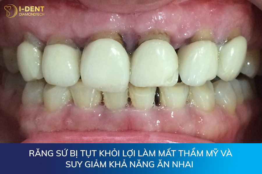 tụt nướu răng sứ