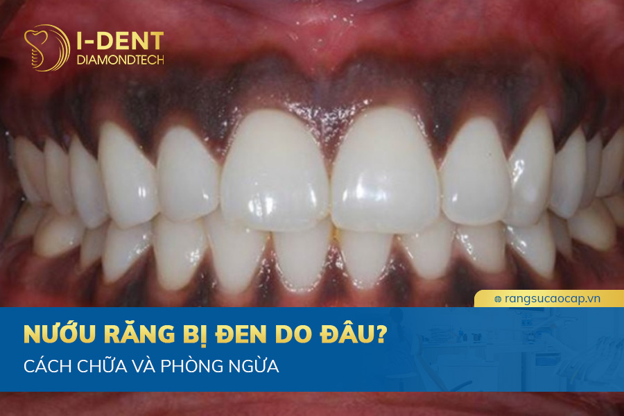 nướu răng bị đen